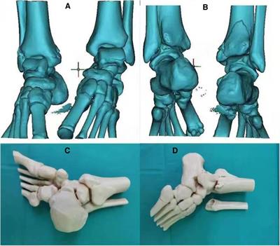 Clinical effects of 3D printing-assisted posterolateral incision in the treatment of ankle fractures involving the posterior malleolus